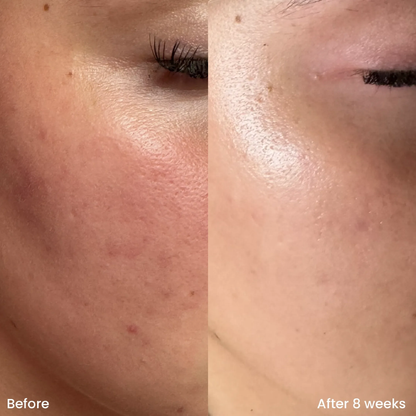 Teashell Niacinamide Brightening Serum | Fade Dark Spots, Acne Marks & Even Skin Tone